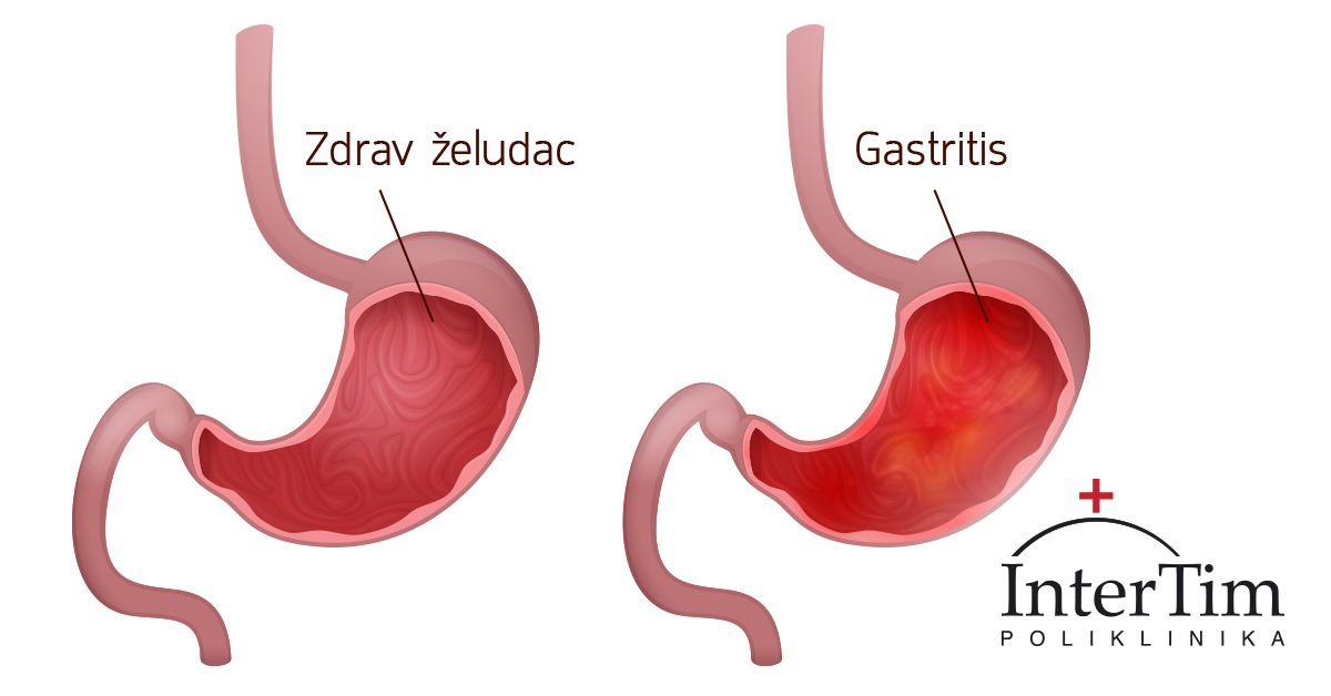 DIJETA ZA GASTRITIS · Poliklinika Intertim